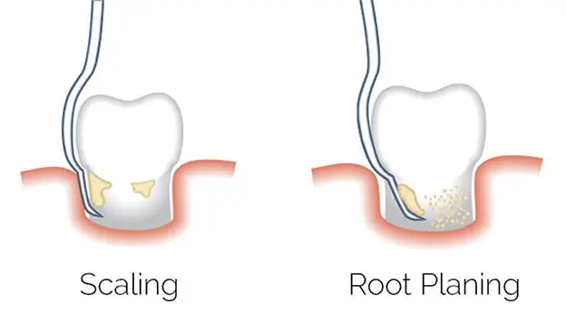 What is scaling and root planing?